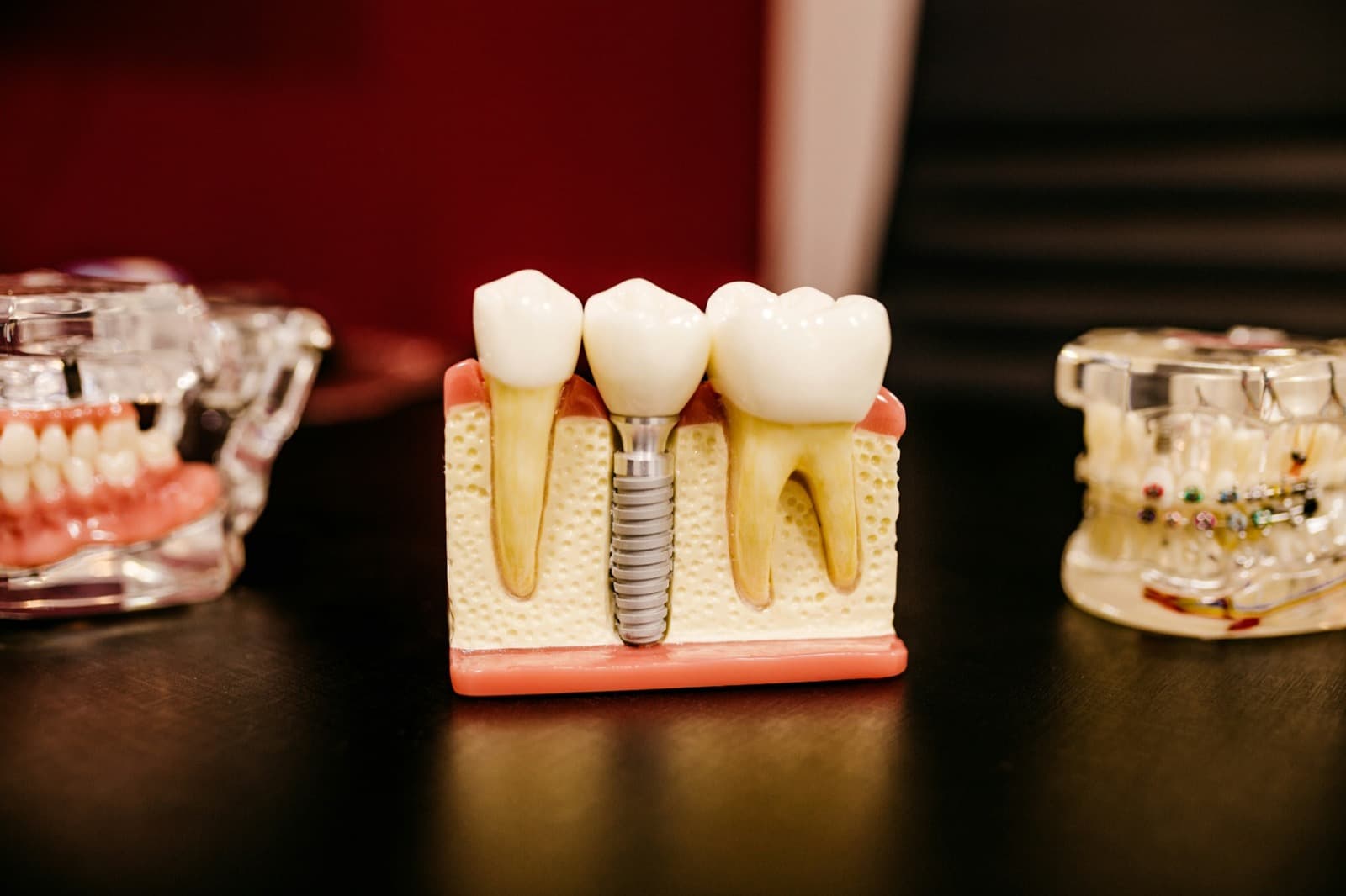 Zahnzusatz für Implantate und Zahnersatz: Leistungen vergleichen